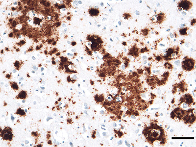 View Of Ab Plaques Free Neuropathology