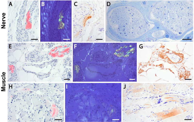 View Of Neuromuscular Disease 2021 Update Free Neuropathology